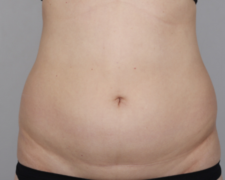 Weiblicher Bauch vor LipoSaver