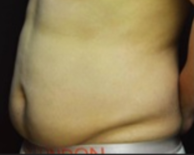 Bauch oblique vor LipoSaver