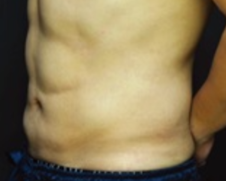 Bauch oblique nach LipoSaver — HD-Definition