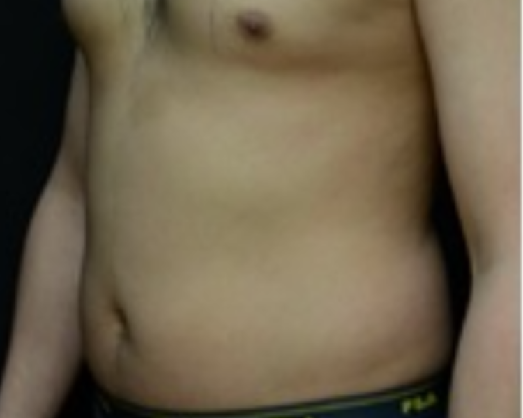 Bauch frontal vor LipoSaver