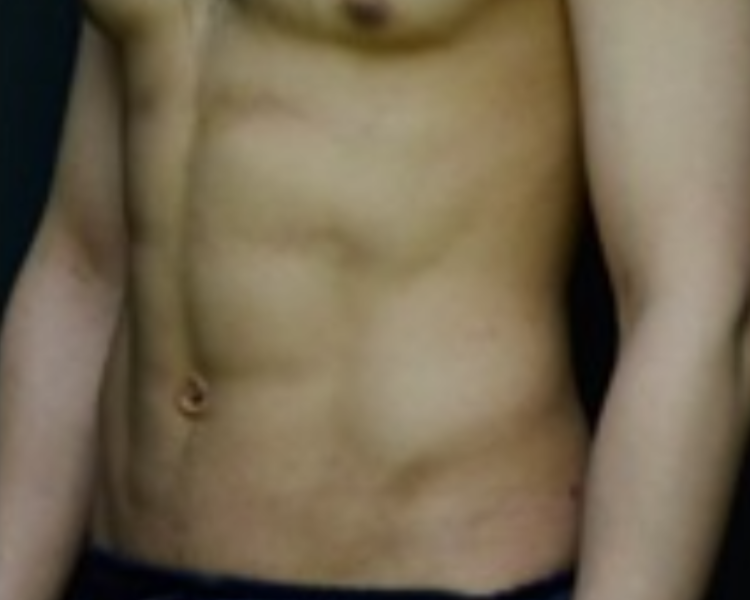 Bauch frontal nach LipoSaver — Six-Pack-Definition