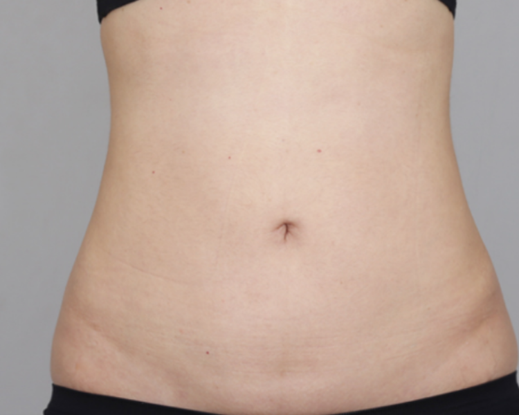 Weiblicher Bauch nach LipoSaver