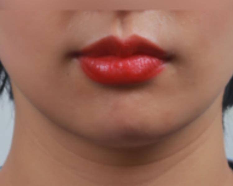 Kinnpartie nach LipoSaver — Facial HD